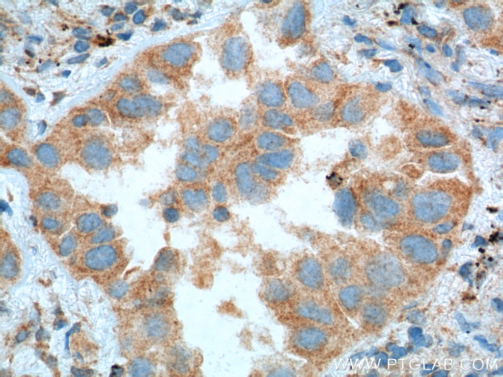 Immunohistochemistry (IHC) staining of human lung cancer tissue using PFN2 Monoclonal antibody (60094-2-Ig)