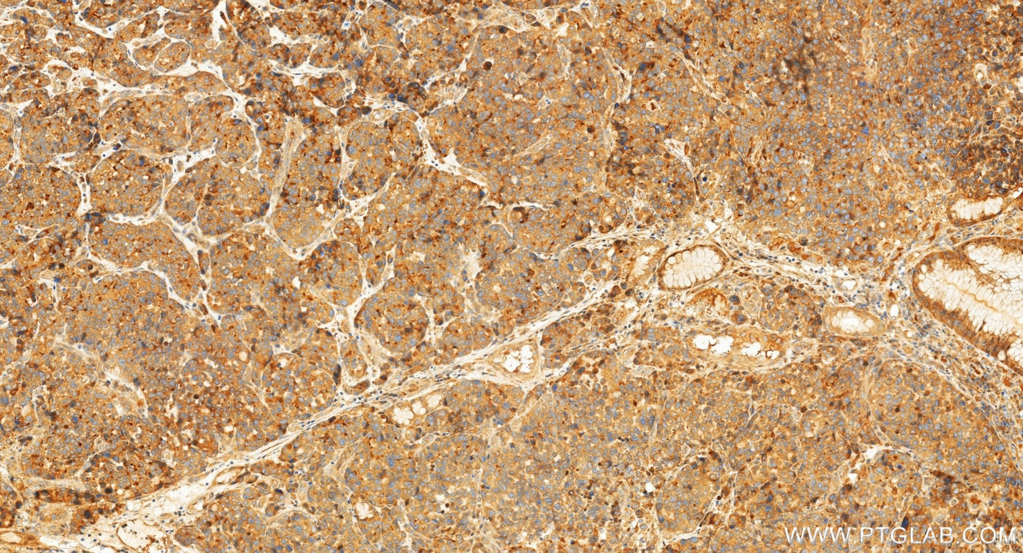 Immunohistochemistry (IHC) staining of human stomach cancer tissue using PGA4 Polyclonal antibody (33764-1-AP)