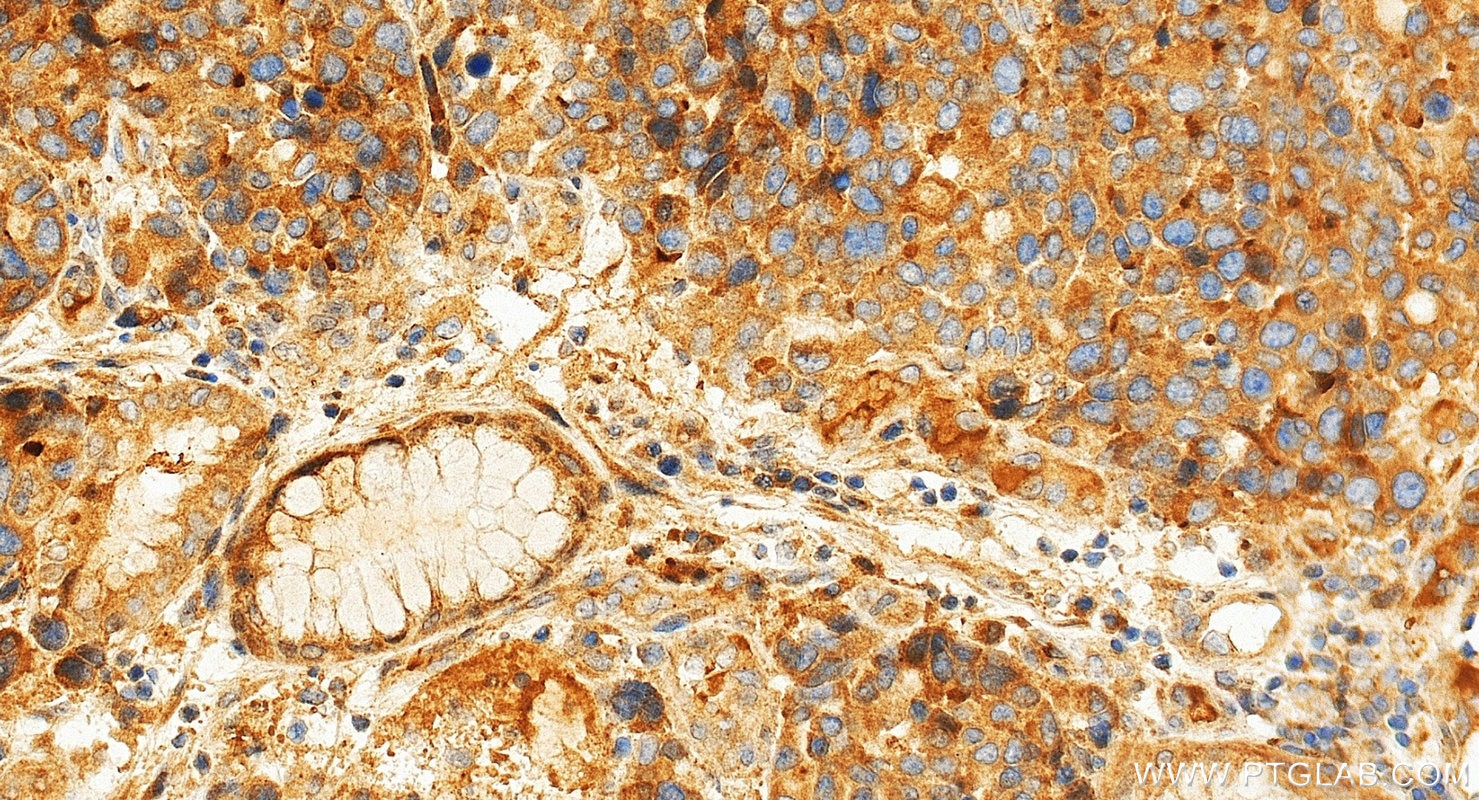 Immunohistochemistry (IHC) staining of human stomach cancer tissue using PGA4 Polyclonal antibody (33764-1-AP)