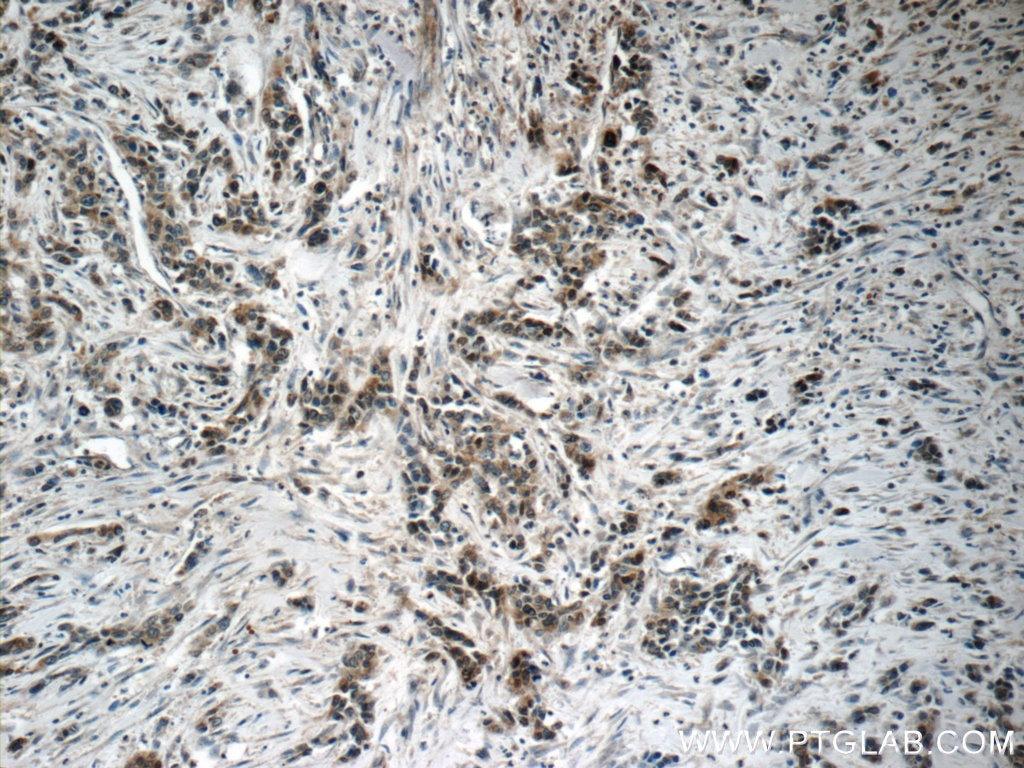 Immunohistochemistry (IHC) staining of human stomach cancer tissue using Pepsinogen I Polyclonal antibody (17330-1-AP)