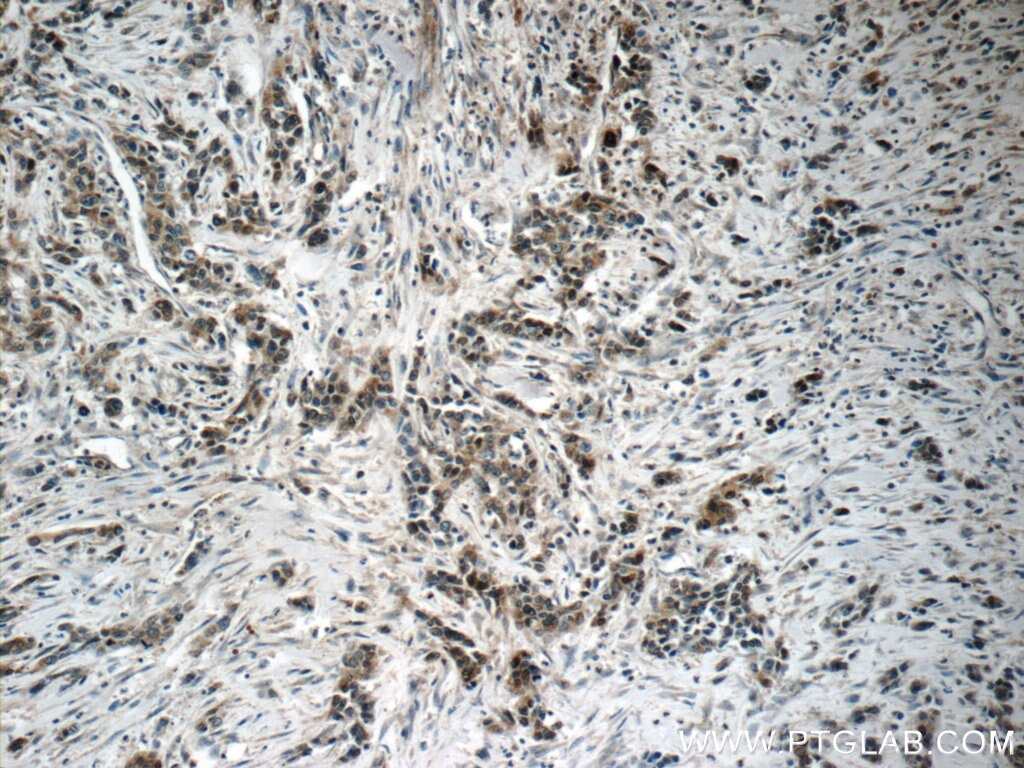 IHC staining of human stomach cancer using 17330-1-AP