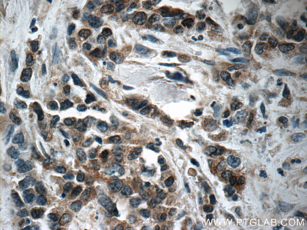 Immunohistochemistry (IHC) staining of human stomach cancer tissue using Pepsinogen I Polyclonal antibody (17330-1-AP)