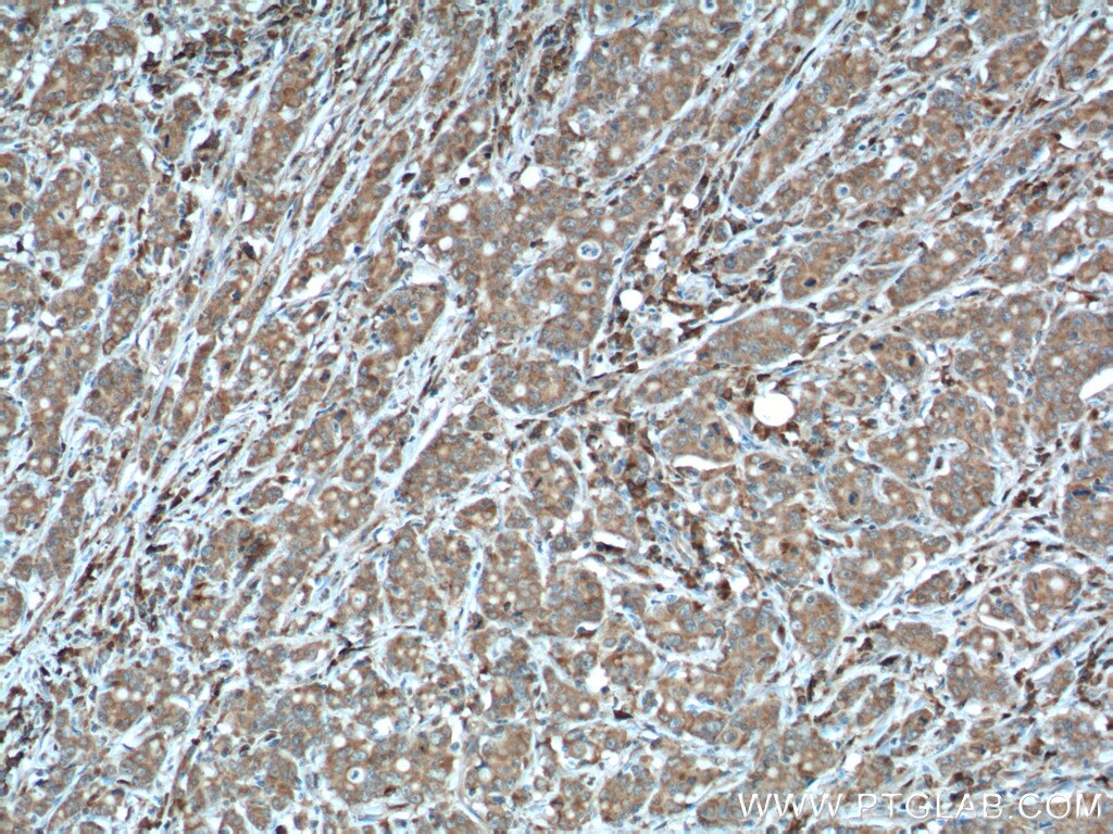 Immunohistochemistry (IHC) staining of human stomach cancer tissue using PGA5 Monoclonal antibody (67848-1-Ig)