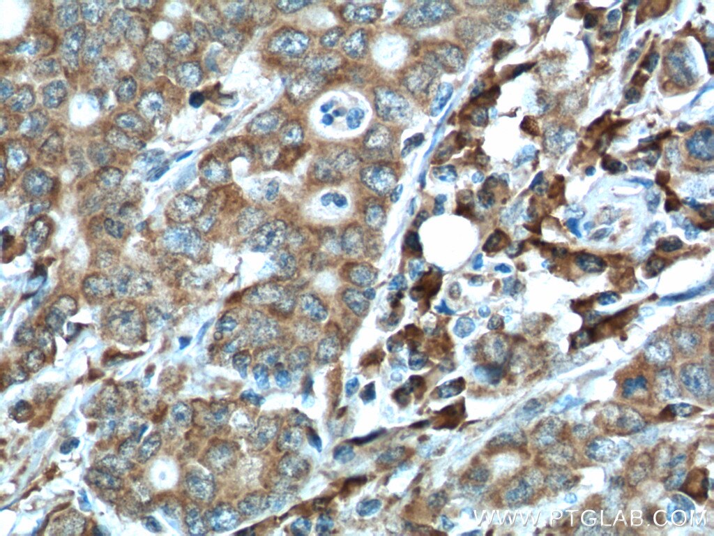 Immunohistochemistry (IHC) staining of human stomach cancer tissue using PGA5 Monoclonal antibody (67848-1-Ig)