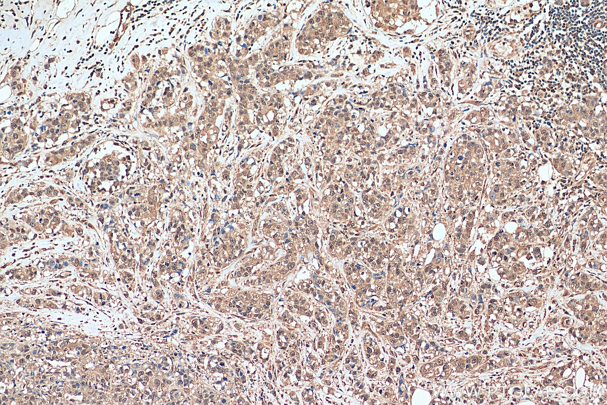 Immunohistochemistry (IHC) staining of human breast cancer tissue using PGAM1 Polyclonal antibody (16126-1-AP)