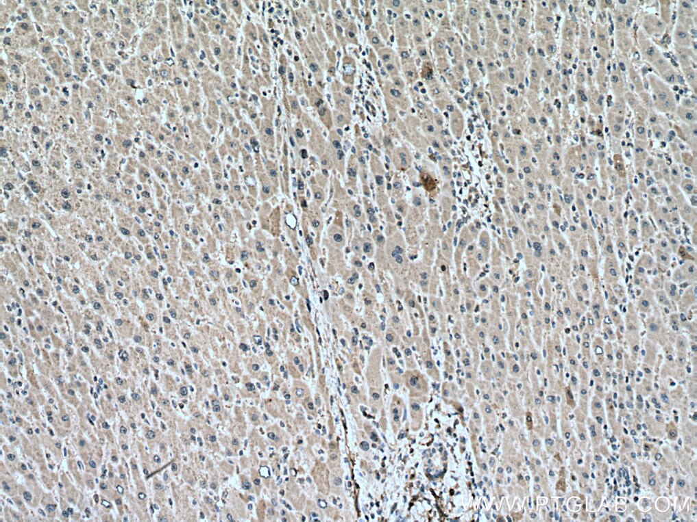 Immunohistochemistry (IHC) staining of human liver cancer tissue using PGAM1 Monoclonal antibody (67470-1-Ig)