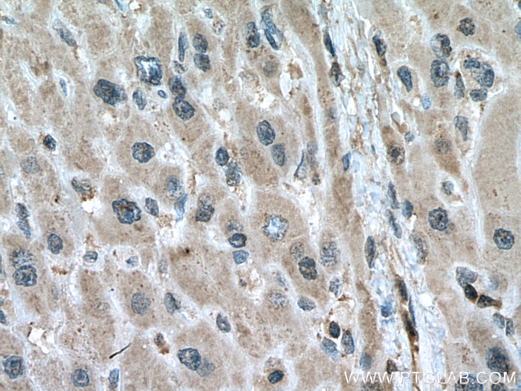 Immunohistochemistry (IHC) staining of human liver cancer tissue using PGAM1 Monoclonal antibody (67470-1-Ig)