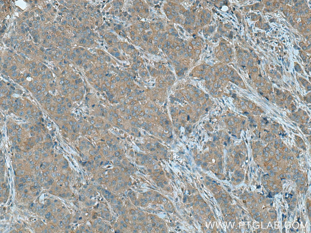 Immunohistochemistry (IHC) staining of human breast cancer tissue using PGAM2 Polyclonal antibody (15550-1-AP)