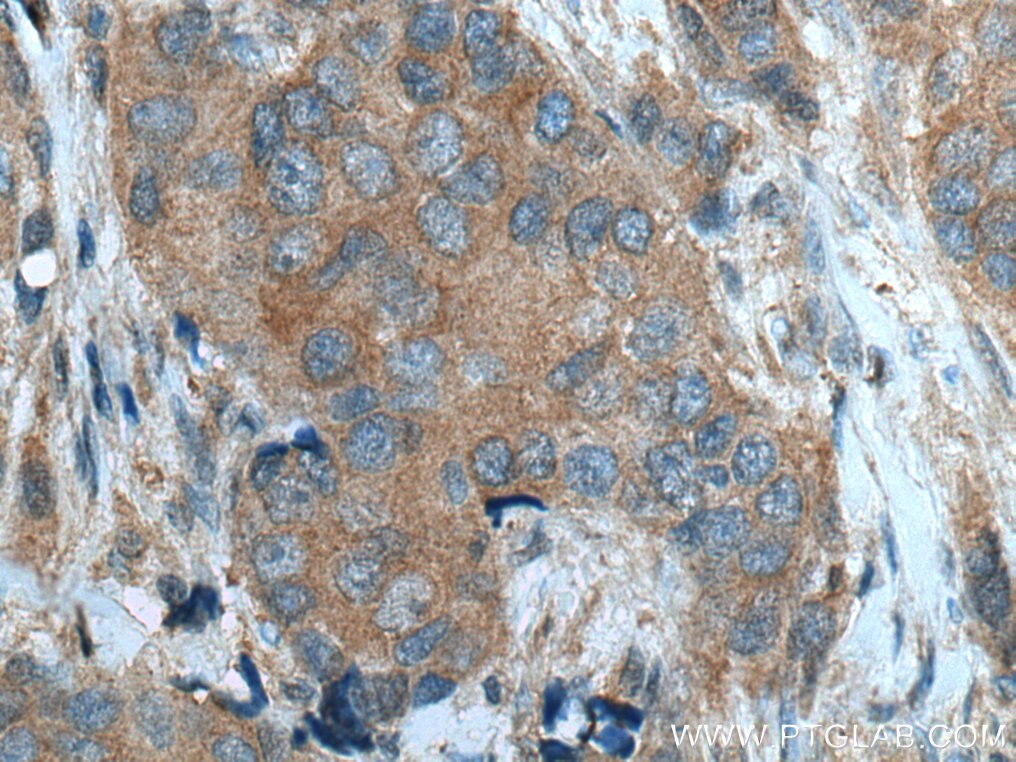 Immunohistochemistry (IHC) staining of human breast cancer tissue using PGAM2 Polyclonal antibody (15550-1-AP)