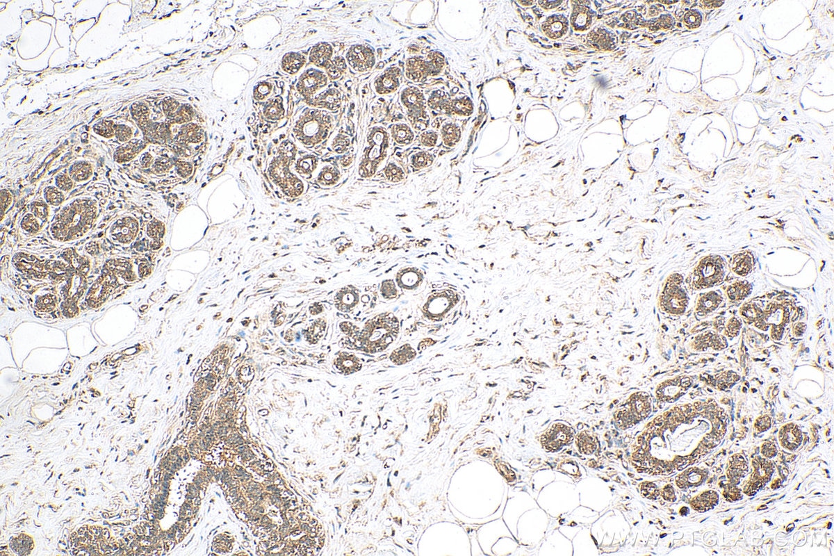 Immunohistochemistry (IHC) staining of human breast cancer tissue using PGAM5 Polyclonal antibody (28445-1-AP)