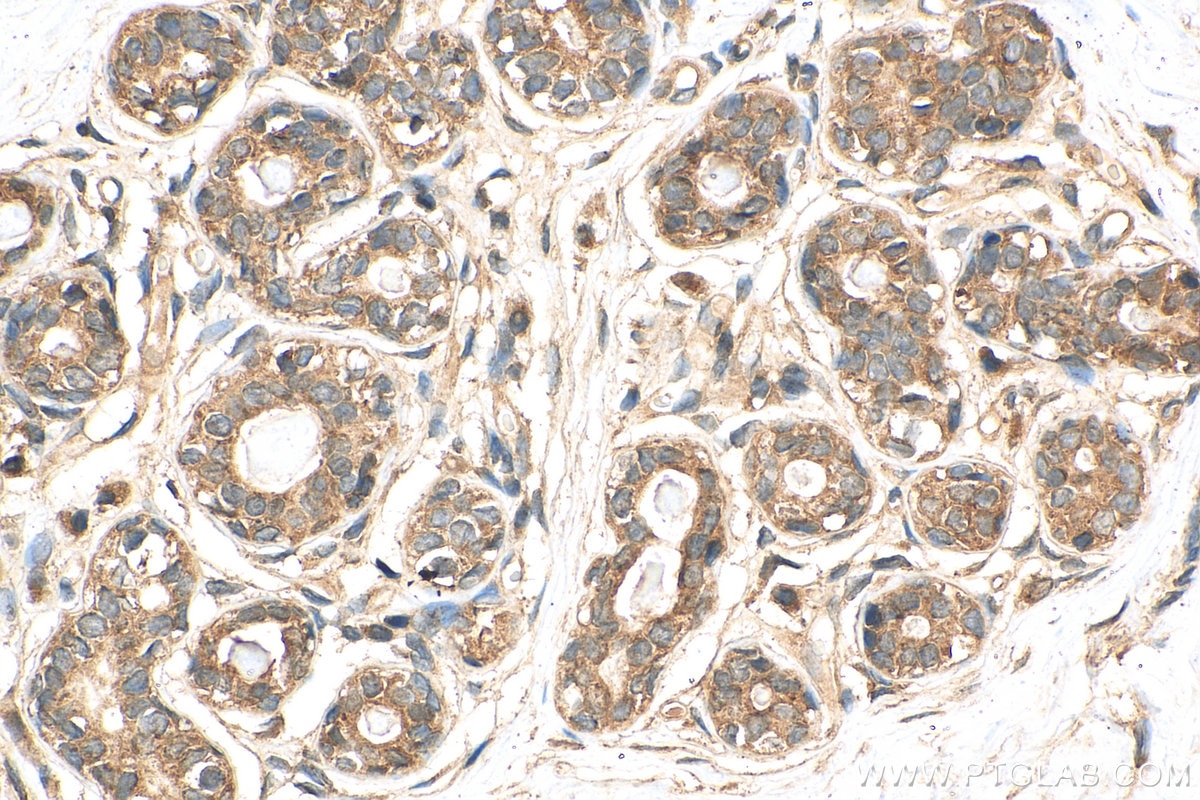 Immunohistochemistry (IHC) staining of human breast cancer tissue using PGAM5 Polyclonal antibody (28445-1-AP)