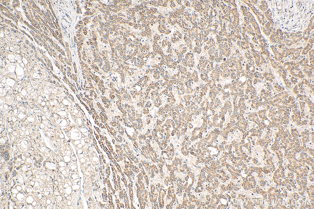 Immunohistochemistry (IHC) staining of human liver cancer tissue using PGAM5 Polyclonal antibody (28445-1-AP)