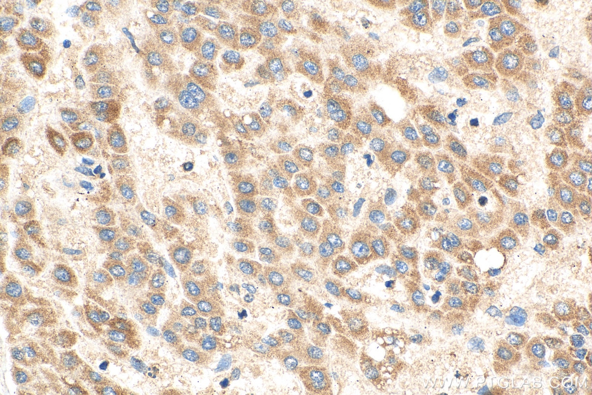 Immunohistochemistry (IHC) staining of human liver cancer tissue using PGAM5 Polyclonal antibody (28445-1-AP)