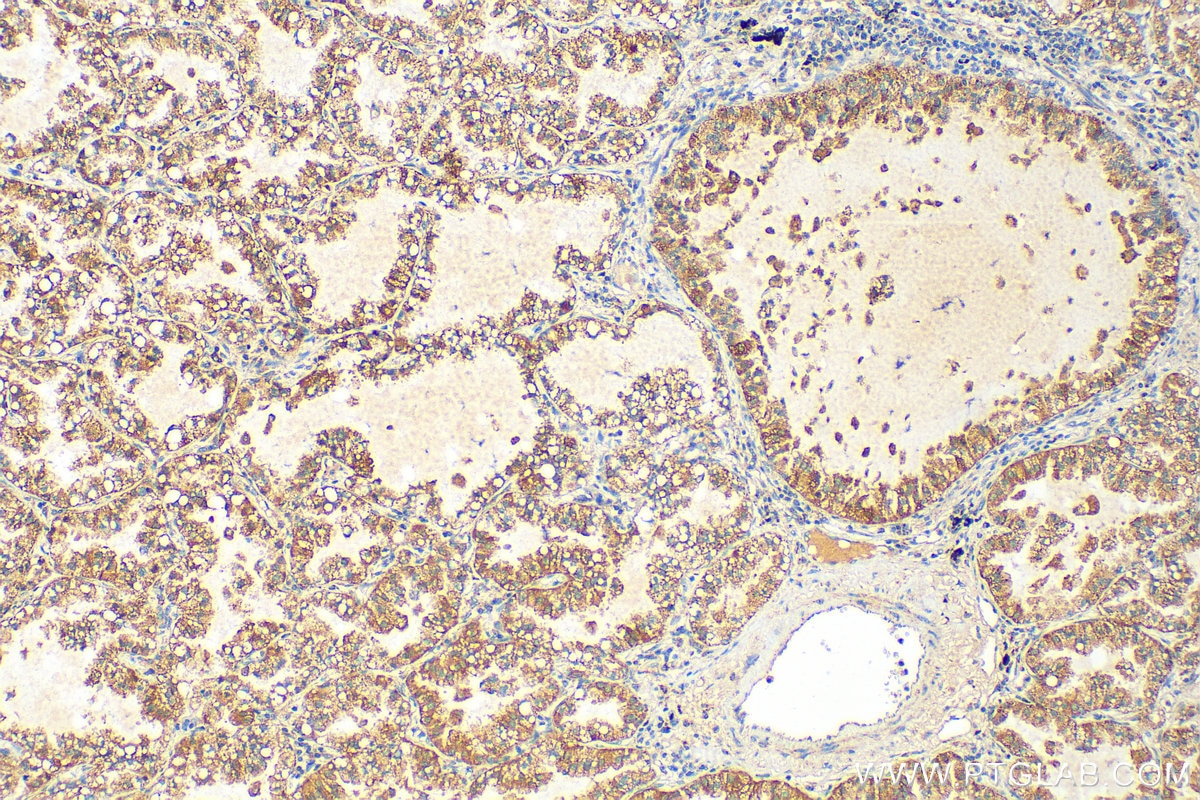 Immunohistochemistry (IHC) staining of human lung cancer tissue using PGAM5 Polyclonal antibody (28445-1-AP)