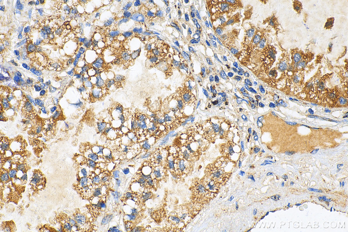 Immunohistochemistry (IHC) staining of human lung cancer tissue using PGAM5 Polyclonal antibody (28445-1-AP)