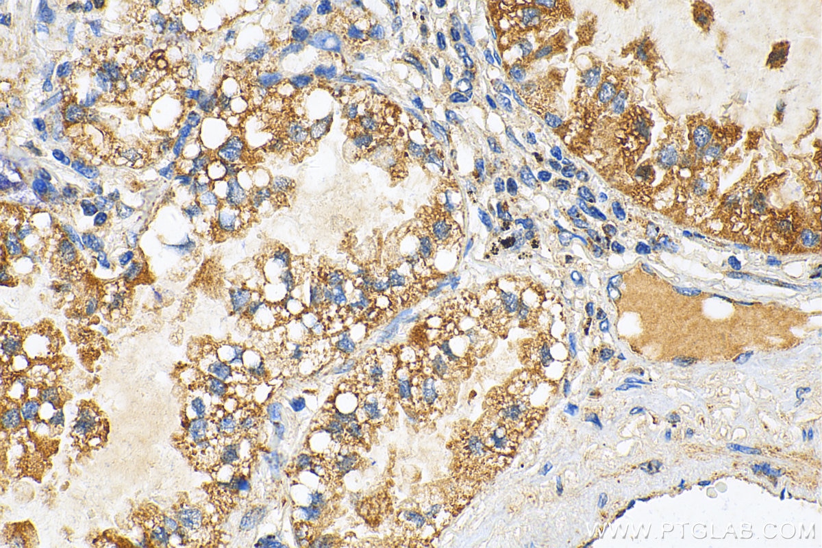 IHC staining of human lung cancer using 28445-1-AP