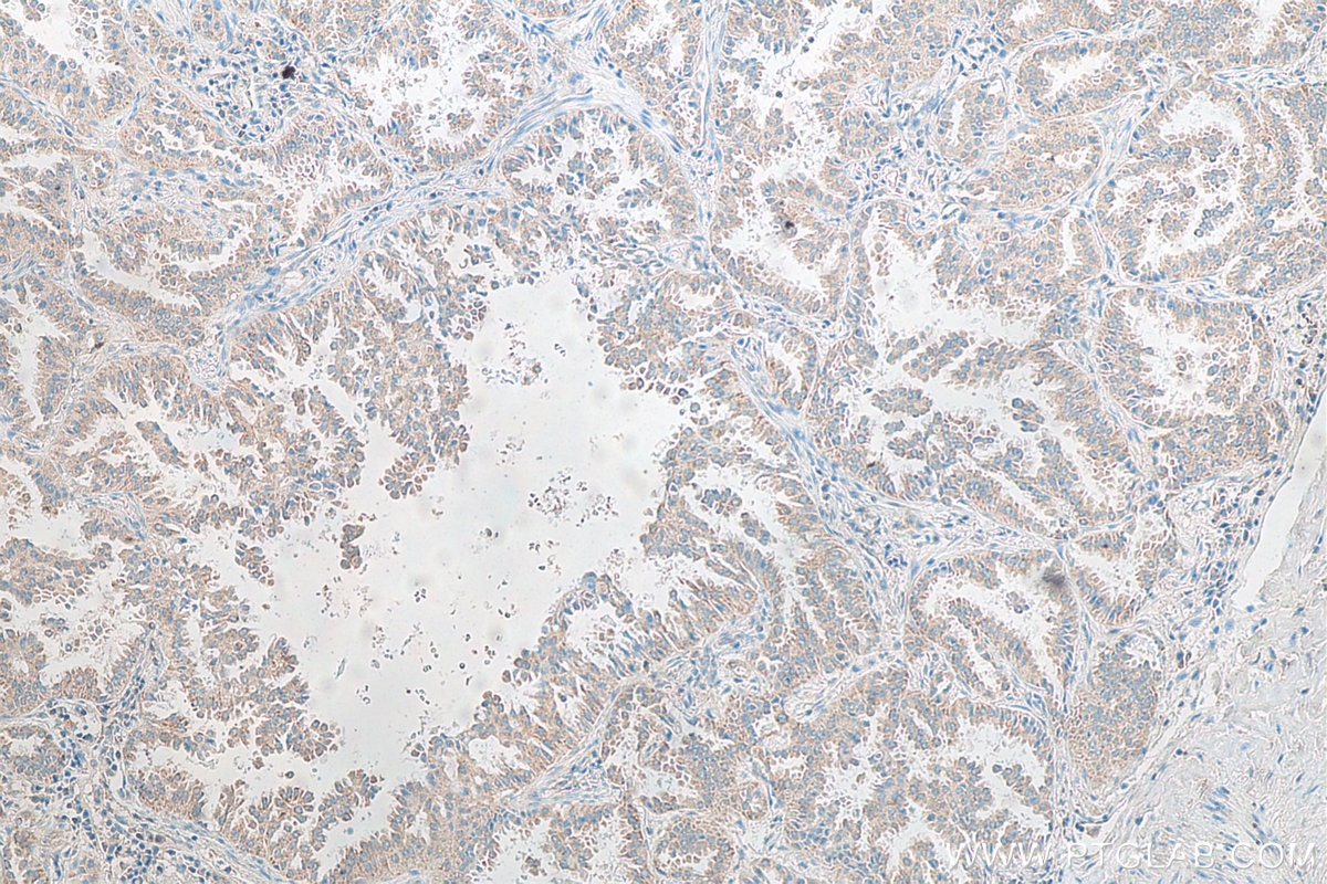 Immunohistochemistry (IHC) staining of human lung cancer tissue using PGAM5 Monoclonal antibody (68116-1-Ig)