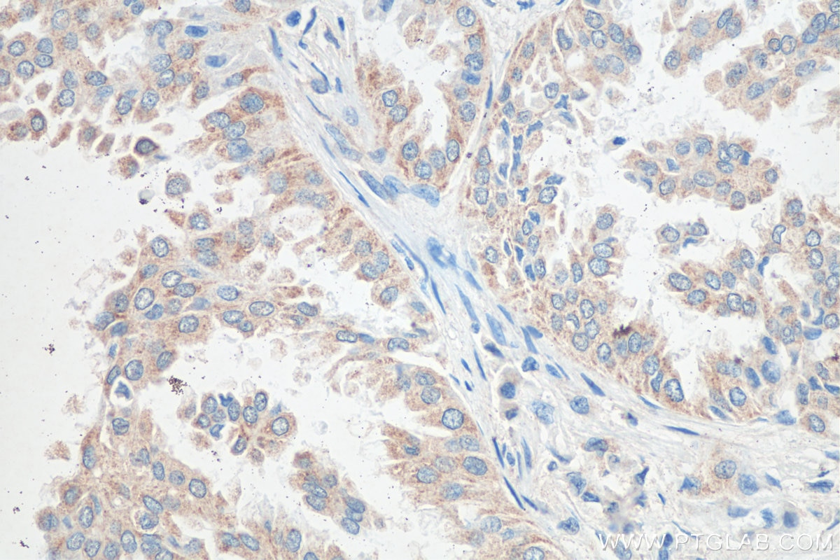 Immunohistochemistry (IHC) staining of human lung cancer tissue using PGAM5 Monoclonal antibody (68116-1-Ig)
