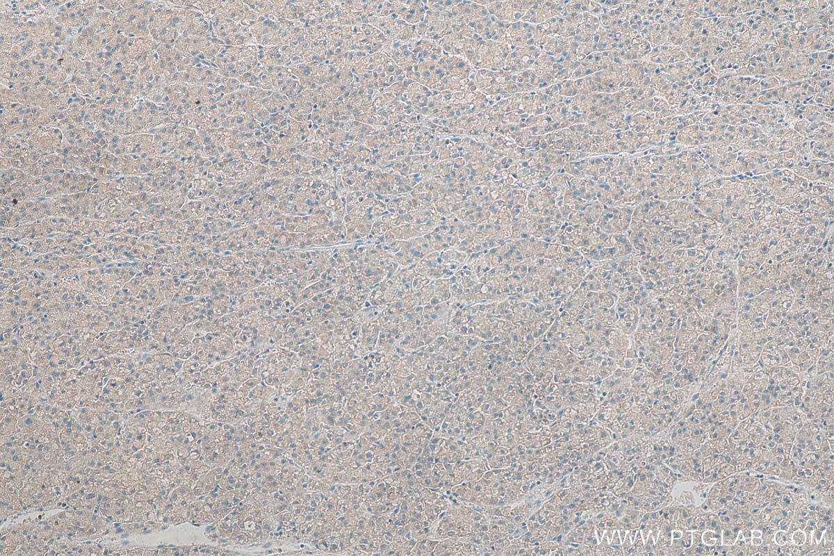IHC staining of human liver cancer using 68116-1-Ig