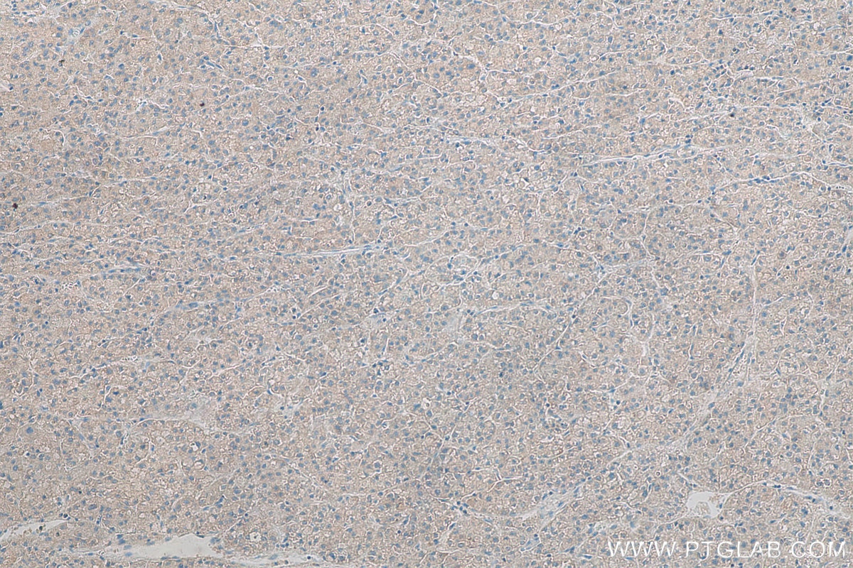 Immunohistochemistry (IHC) staining of human liver cancer tissue using PGAM5 Monoclonal antibody (68116-1-Ig)