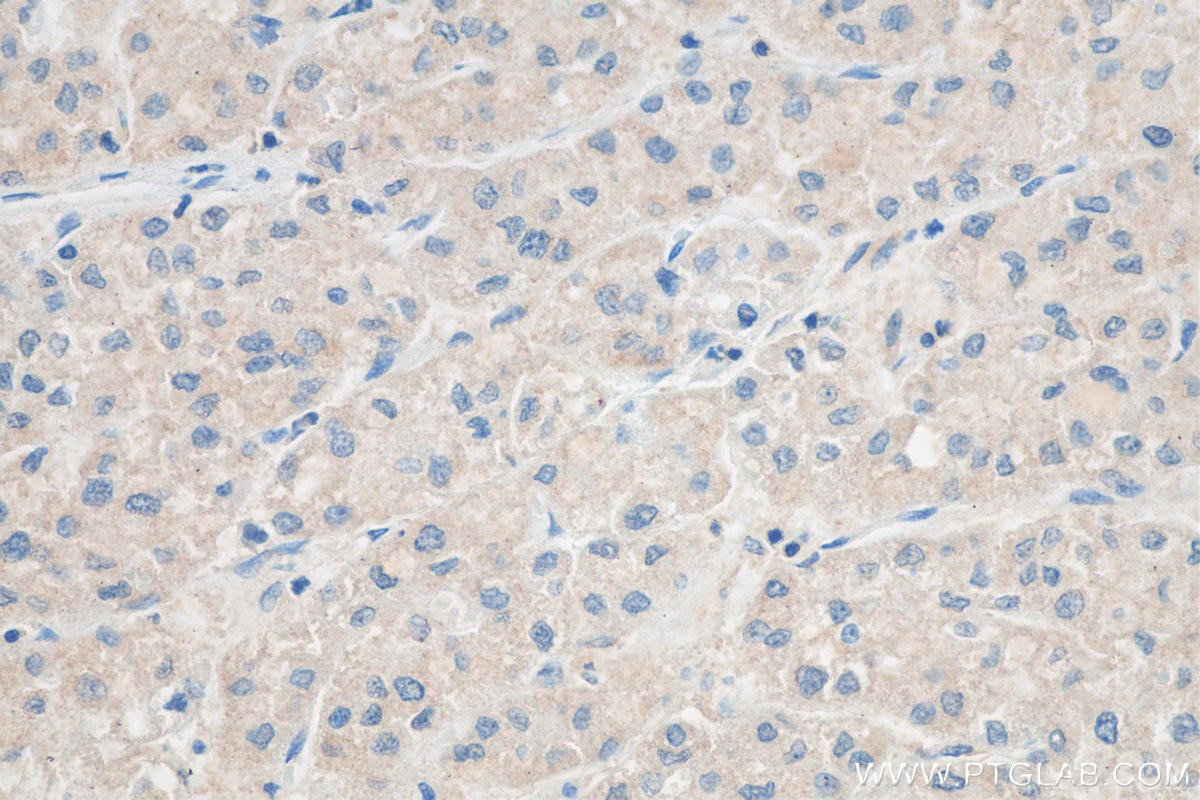 Immunohistochemistry (IHC) staining of human liver cancer tissue using PGAM5 Monoclonal antibody (68116-1-Ig)