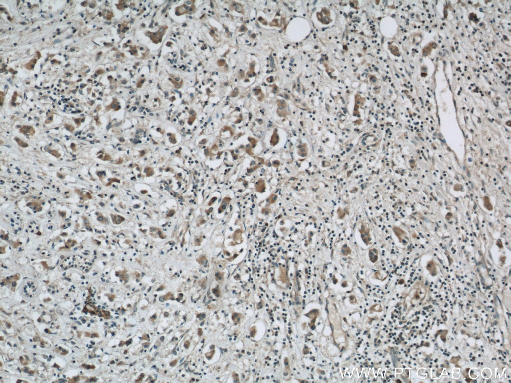 Immunohistochemistry (IHC) staining of human breast cancer tissue using PGAP1 Polyclonal antibody (55392-1-AP)