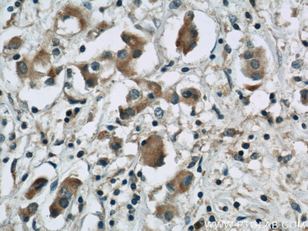 Immunohistochemistry (IHC) staining of human breast cancer tissue using PGAP1 Polyclonal antibody (55392-1-AP)