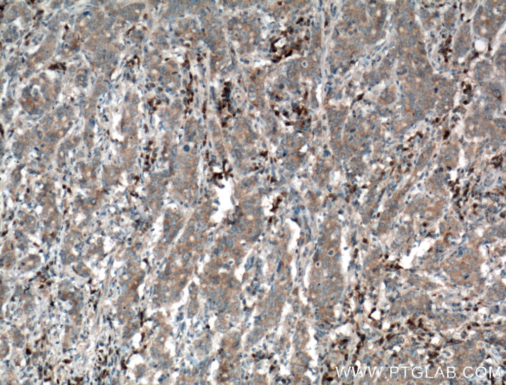 Immunohistochemistry (IHC) staining of human stomach cancer tissue using Pepsinogen II Polyclonal antibody (16881-1-AP)