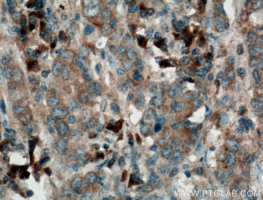 Immunohistochemistry (IHC) staining of human stomach cancer tissue using Pepsinogen II Polyclonal antibody (16881-1-AP)