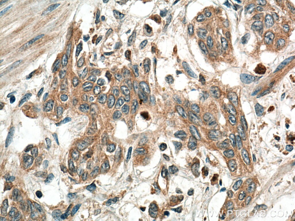 Immunohistochemistry (IHC) staining of human stomach cancer tissue using PGC Polyclonal antibody (28532-1-AP)