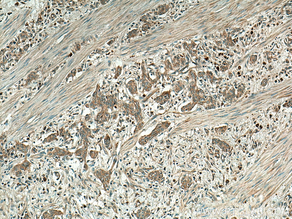 Immunohistochemistry (IHC) staining of human stomach cancer tissue using PGC Polyclonal antibody (28532-1-AP)