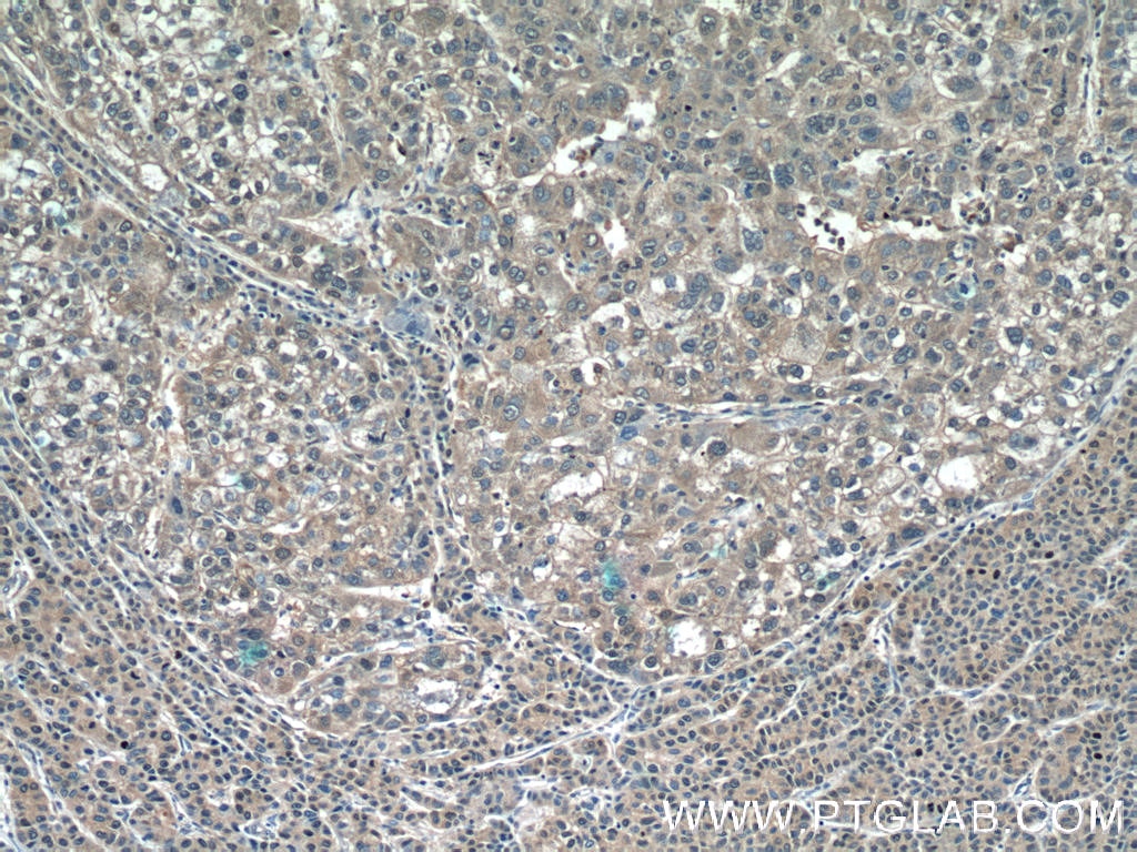 Immunohistochemistry (IHC) staining of human liver cancer tissue using PGD Polyclonal antibody (14718-1-AP)