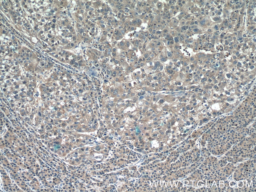 IHC staining of human liver cancer using 14718-1-AP