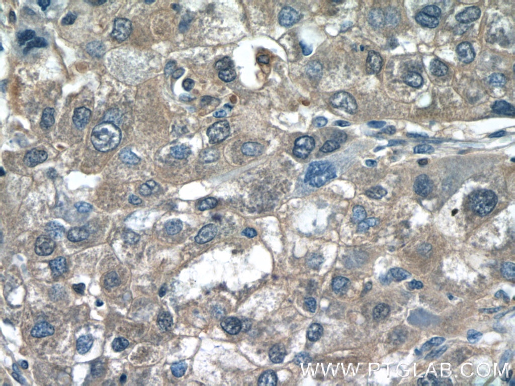 IHC staining of human liver cancer using 14718-1-AP