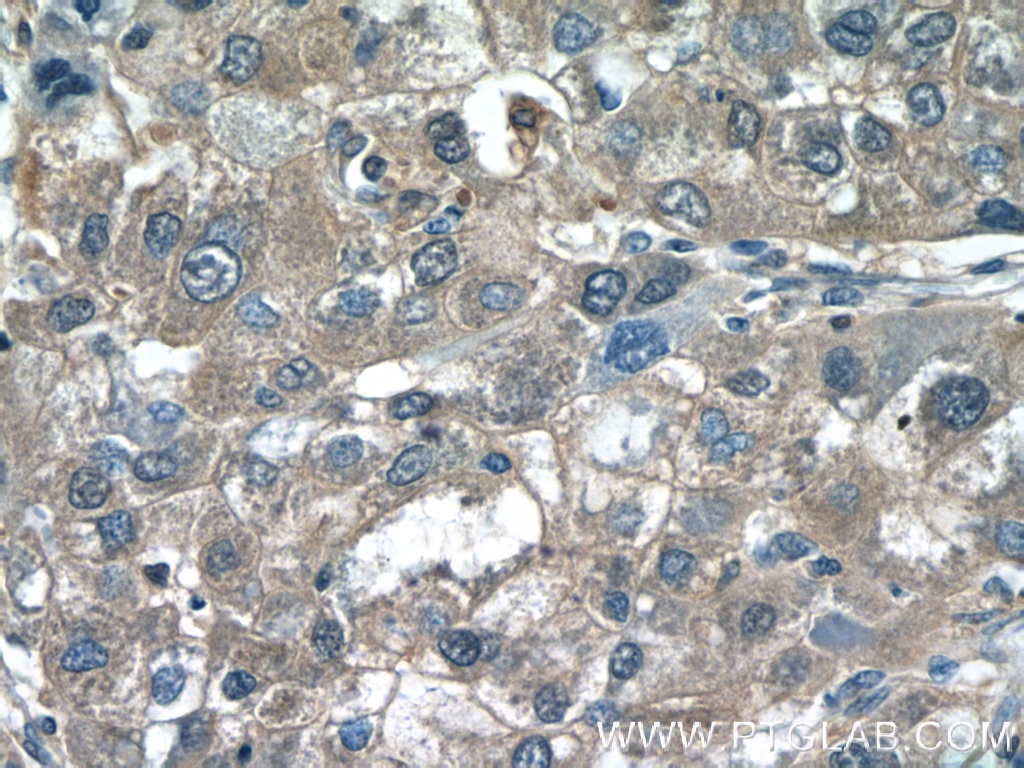 Immunohistochemistry (IHC) staining of human liver cancer tissue using PGD Polyclonal antibody (14718-1-AP)