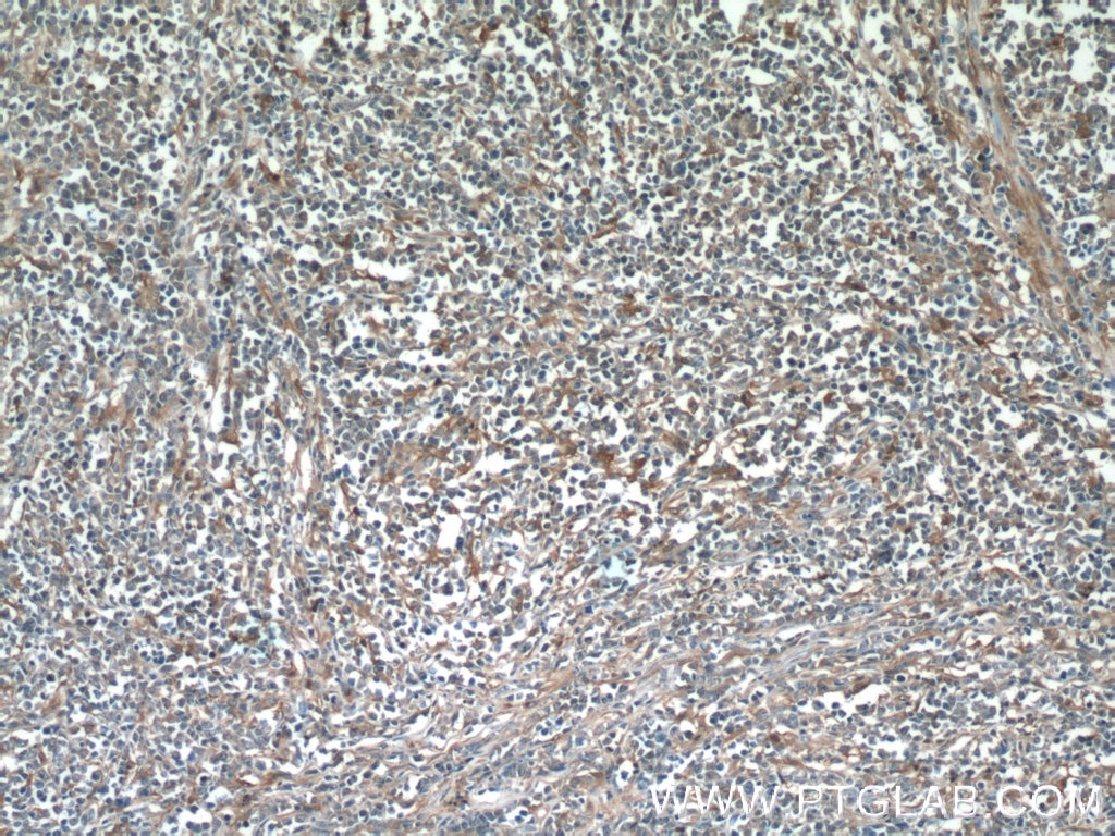 Immunohistochemistry (IHC) staining of human lymphoma tissue using PGD Polyclonal antibody (14718-1-AP)