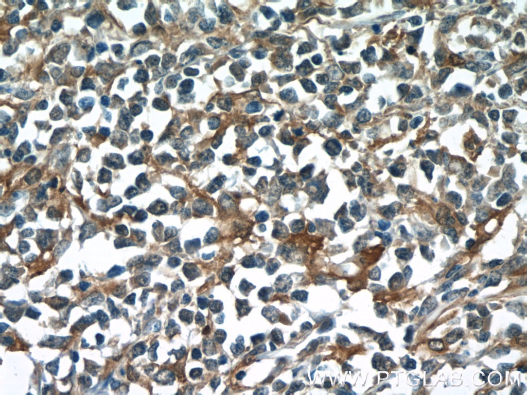 Immunohistochemistry (IHC) staining of human lymphoma tissue using PGD Polyclonal antibody (14718-1-AP)