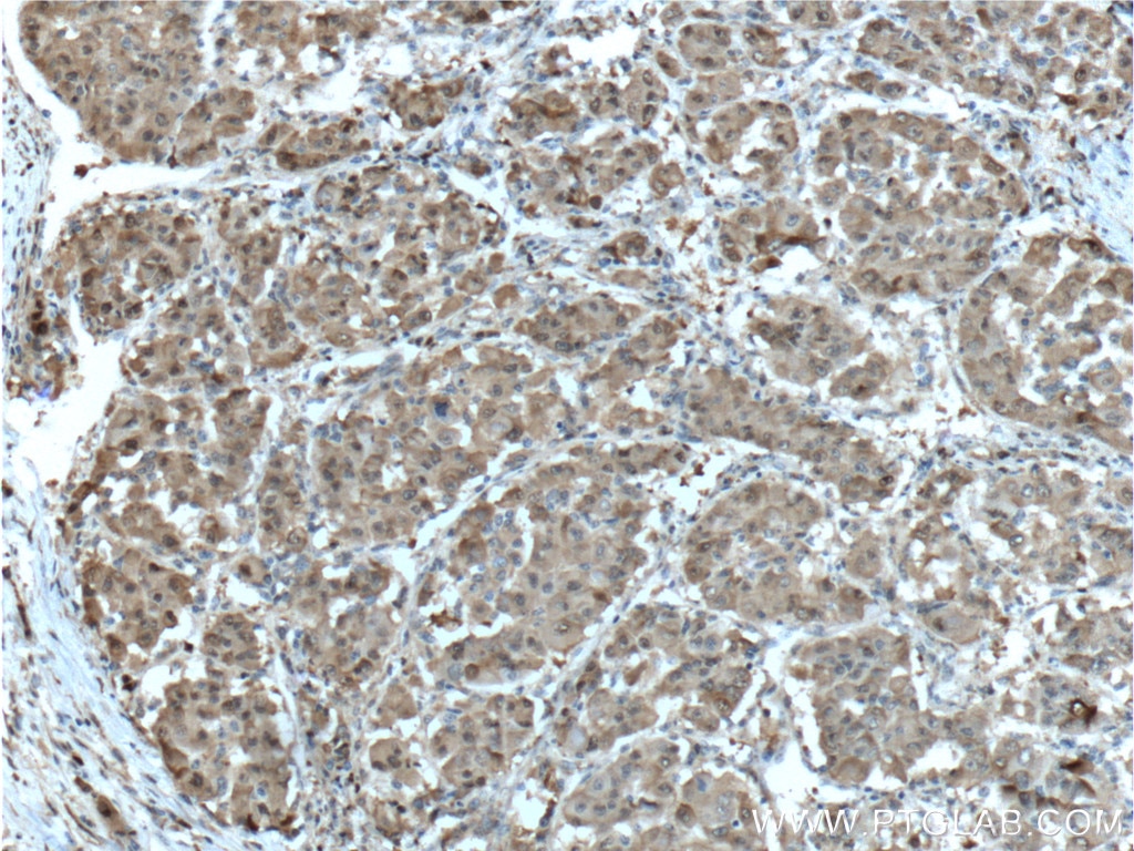 Immunohistochemistry (IHC) staining of human liver cancer tissue using PGD Polyclonal antibody (14718-1-AP)