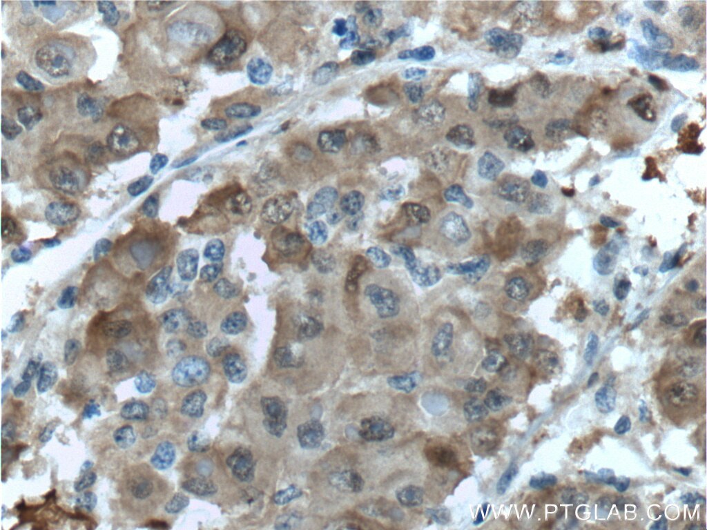 Immunohistochemistry (IHC) staining of human liver cancer tissue using PGD Polyclonal antibody (14718-1-AP)