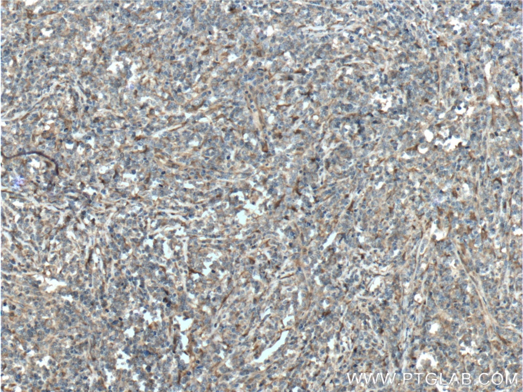 Immunohistochemistry (IHC) staining of human lymphoma tissue using PGD Polyclonal antibody (14718-1-AP)