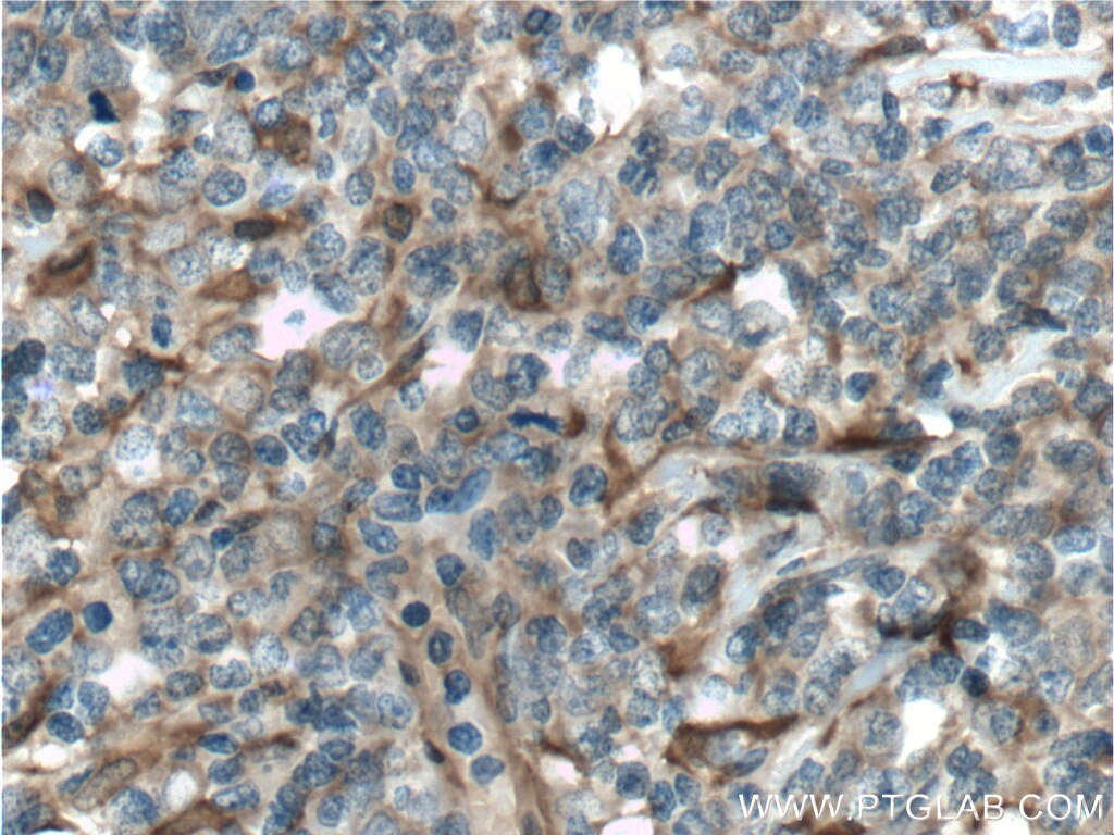 Immunohistochemistry (IHC) staining of human lymphoma tissue using PGD Polyclonal antibody (14718-1-AP)