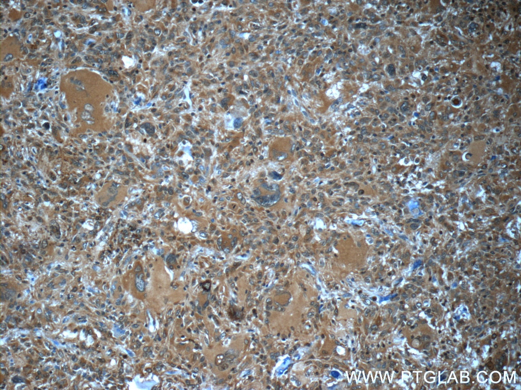 Immunohistochemistry (IHC) staining of human gliomas tissue using HPGDS Polyclonal antibody (22522-1-AP)