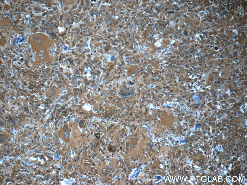 IHC staining of human gliomas using 22522-1-AP