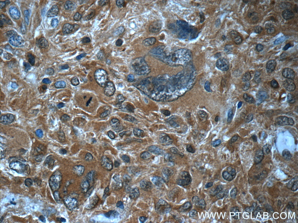 Immunohistochemistry (IHC) staining of human gliomas tissue using HPGDS Polyclonal antibody (22522-1-AP)