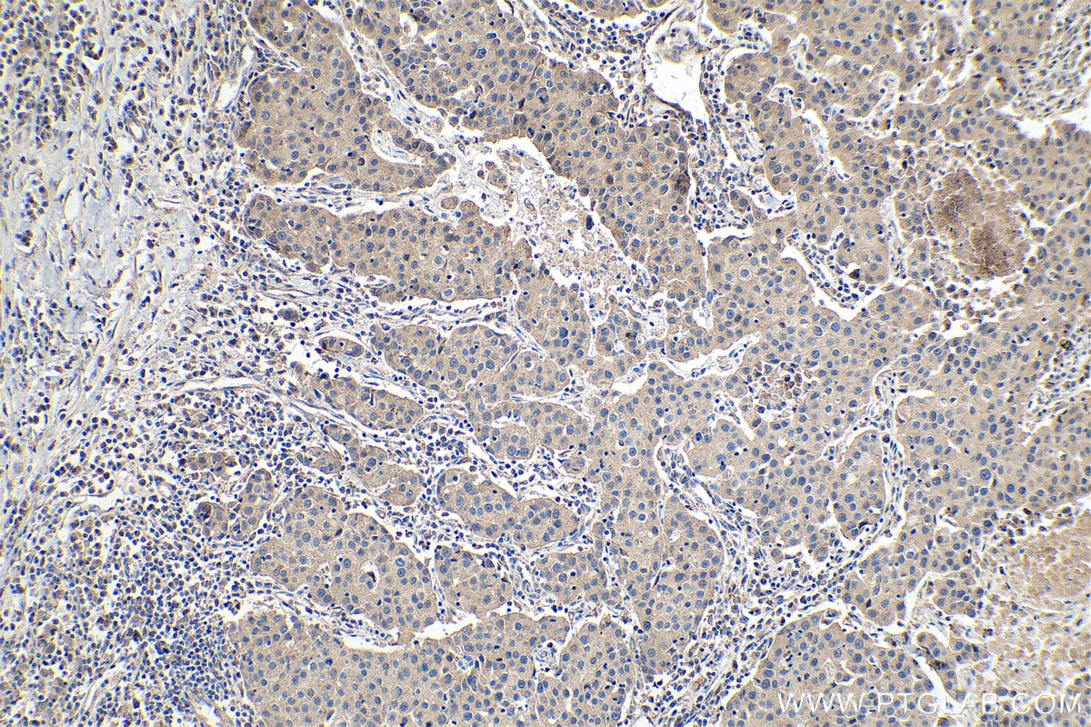 Immunohistochemistry (IHC) staining of human breast cancer tissue using Placental Growth Factor Polyclonal antibody (10642-1-AP)