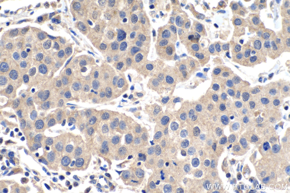 Immunohistochemistry (IHC) staining of human breast cancer tissue using Placental Growth Factor Polyclonal antibody (10642-1-AP)