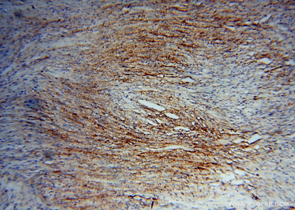 Immunohistochemistry (IHC) staining of human meningioma tissue using Placental Growth Factor Polyclonal antibody (10642-1-AP)