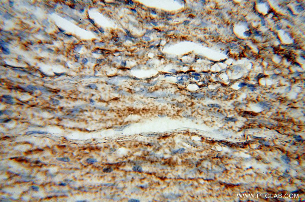 Immunohistochemistry (IHC) staining of human meningioma tissue using Placental Growth Factor Polyclonal antibody (10642-1-AP)