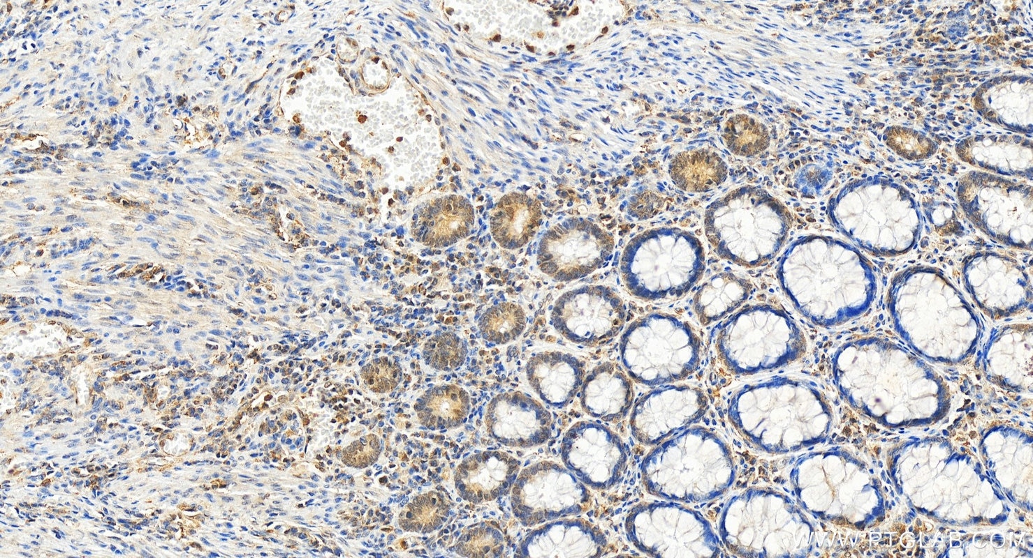 Immunohistochemistry (IHC) staining of human colon cancer tissue using PGK1 Polyclonal antibody (17811-1-AP)