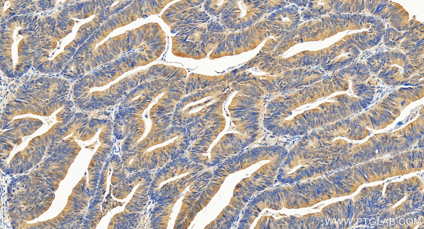 Immunohistochemistry (IHC) staining of human colon cancer tissue using PGK1 Polyclonal antibody (17811-1-AP)